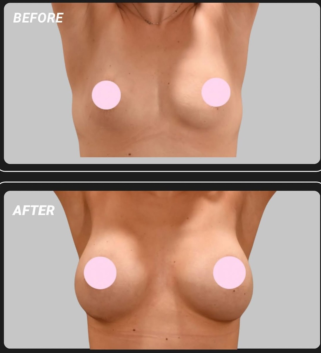 Breast Implant Before and After Result 1